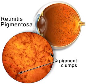 Retinitis Pigmentosa